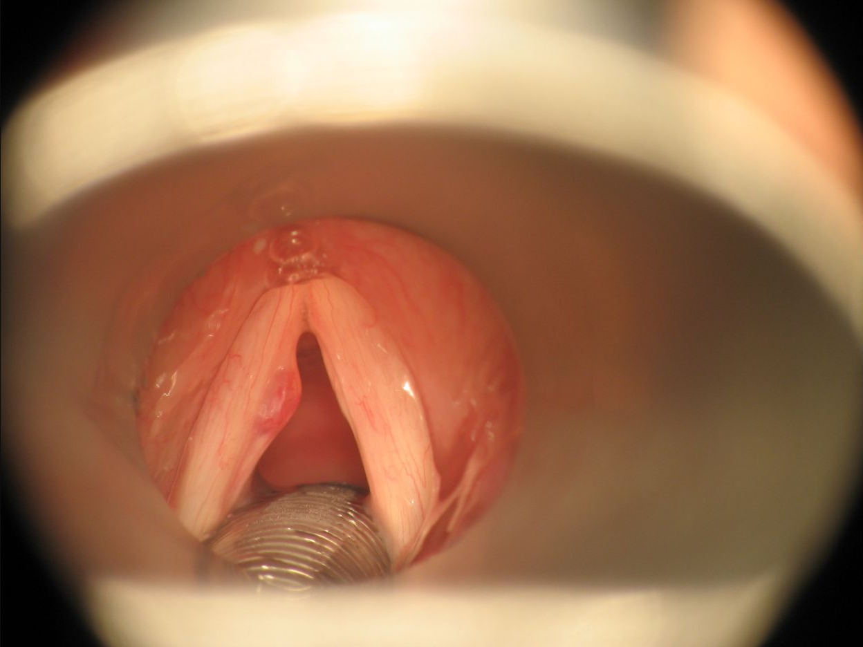 Hình polyp dây thanh nhìn qua ống soi; polyp thường nổi bật một bên và làm bờ rung không đều.