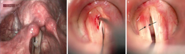 Ba thời điểm sau bóc tách u nang dây thanh trong một ca minh họa; bảo tồn lớp rung là mục tiêu quan trọng.