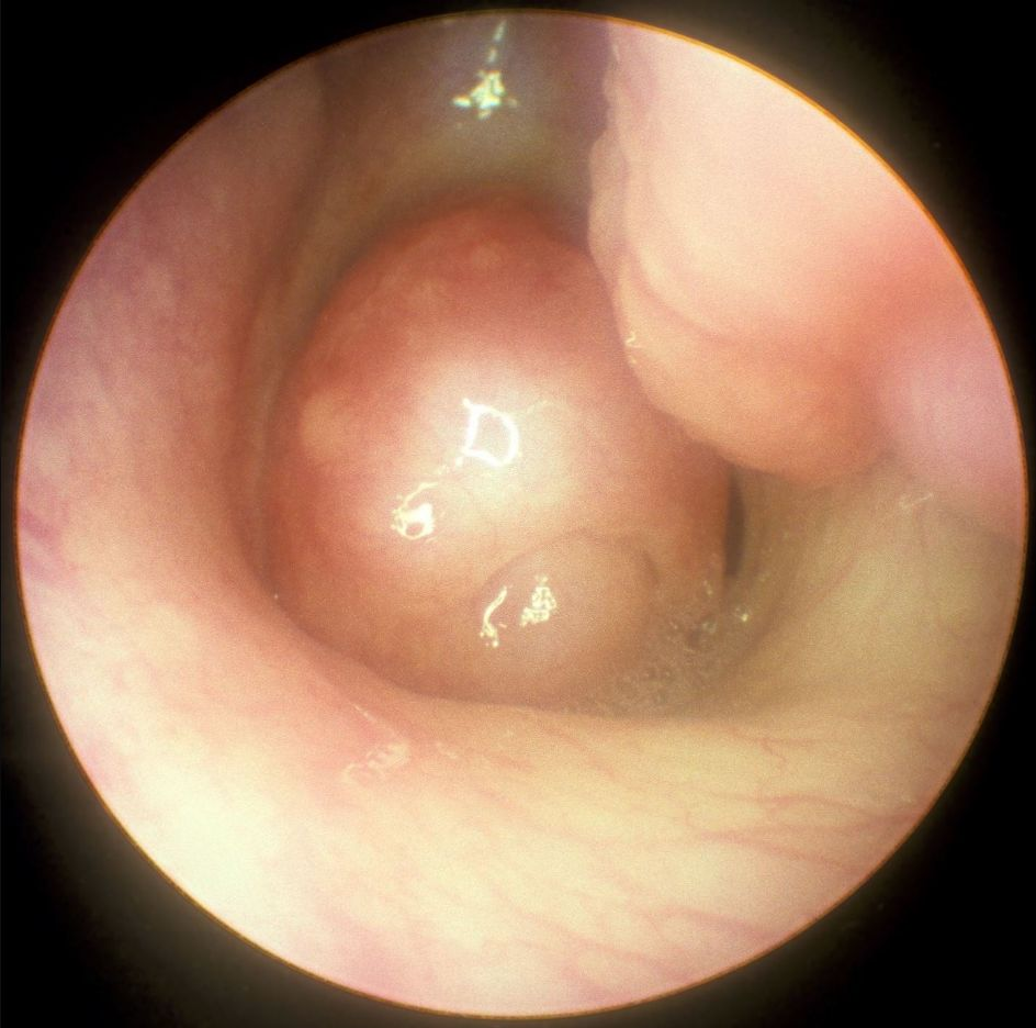 Hình nội soi polyp vùng cửa mũi sau, minh họa một nguyên nhân nghẹt cần phân biệt với viêm mũi dị ứng.