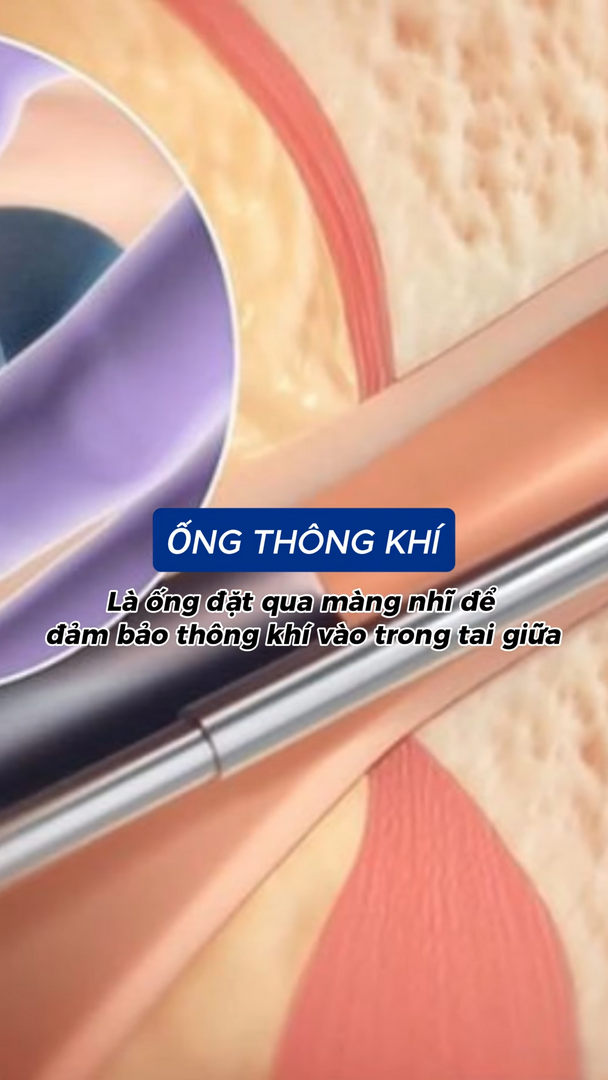 Đặt ống thông khí tai